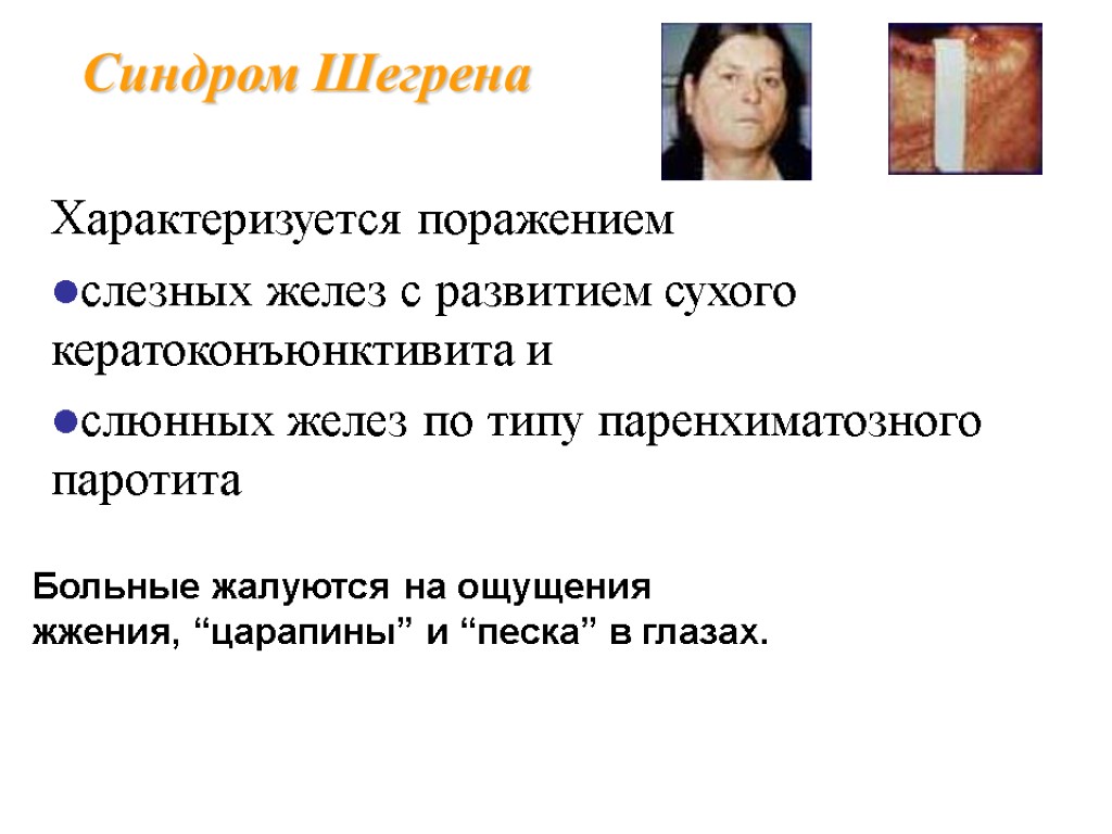 Синдром Шегрена Характеризуется поражением слезных желез с развитием сухого кератоконъюнктивита и слюнных желез по